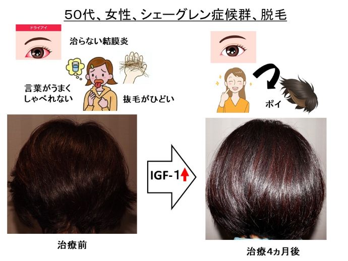 円形脱毛症　名医